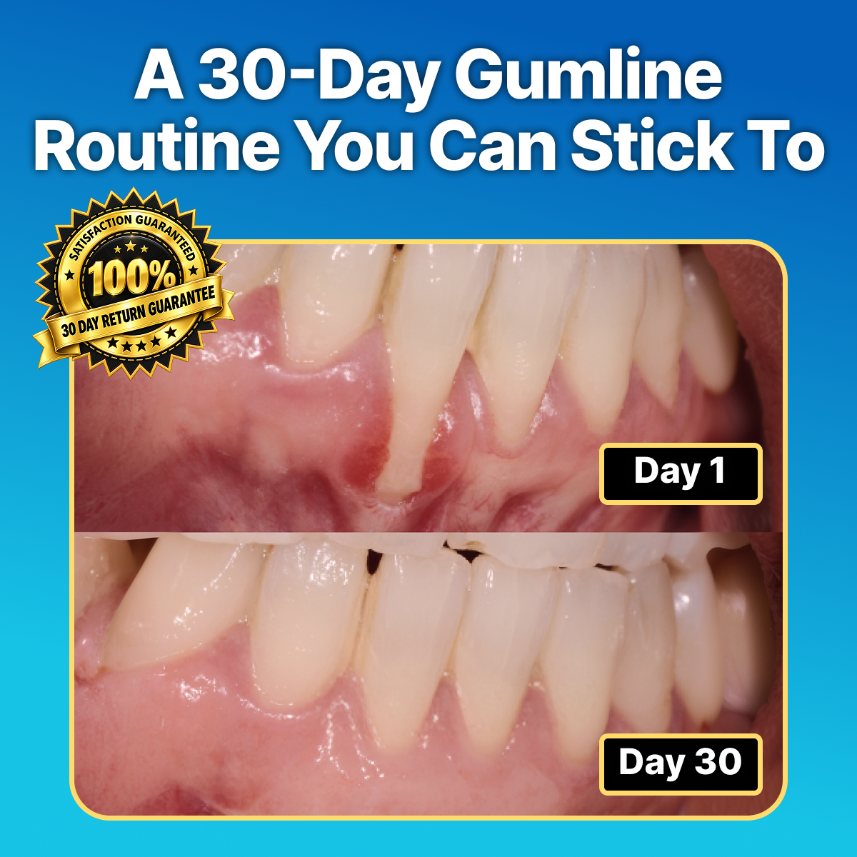 Simple, effective gum support